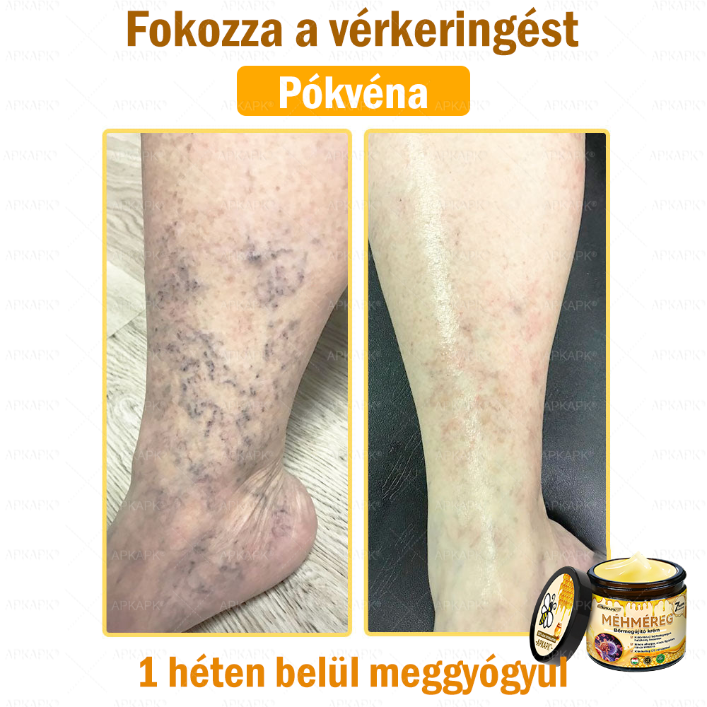 ✨💜💜APKAPK® 𝐌É𝐇𝐌É𝐑𝐄𝐆 Á𝐓𝐅𝐎𝐆Ó 𝐊𝐑É𝐌🥇𝐀 bőrnövedékek 𝐤𝐞𝐳𝐞𝐥é𝐬𝐞 𝐦𝐚𝐠á𝐛𝐚𝐧 𝐟𝐨𝐠𝐥𝐚𝐥𝐣𝐚: é𝐥𝐞𝐭𝐤𝐨𝐫𝐢 𝐟𝐨𝐥𝐭𝐨𝐤, 𝐡𝐞𝐠𝐞𝐤, 𝐬𝐳𝐞𝐦ö𝐥𝐜𝐬ö𝐤, 𝐛ö𝐫𝐧ö𝐯𝐞𝐝é𝐤𝐞𝐤, 𝐭á𝐥𝐲𝐨𝐠𝐨𝐤, 𝐩𝐚𝐭𝐭𝐚𝐧á𝐬𝐨𝐤, 𝐞𝐤𝐜é𝐦𝐚, 𝐩𝐬𝐨𝐫𝐢𝐚𝐬𝐢𝐬, 𝐚𝐜𝐧𝐞 𝐢𝐧𝐯𝐞𝐫𝐬𝐚, 𝐫á𝐧𝐜𝐨𝐤, 𝐛ö𝐫ö𝐫𝐞𝐠𝐞𝐝é𝐬 é𝐬 𝐞𝐠𝐲é𝐛 𝐩𝐫𝐨𝐛𝐥é𝐦á𝐤🔥