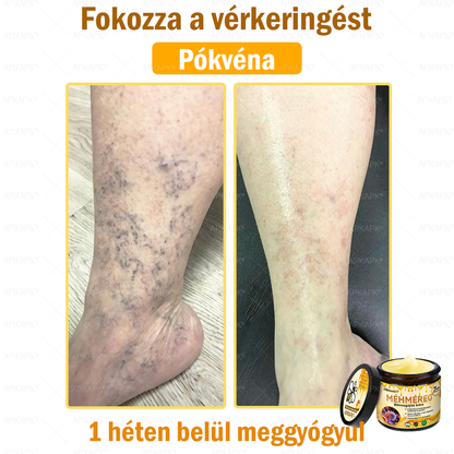 ✨💜💜APKAPK® 𝐌É𝐇𝐌É𝐑𝐄𝐆 Á𝐓𝐅𝐎𝐆Ó 𝐊𝐑É𝐌🥇𝐀 bőrnövedékek 𝐤𝐞𝐳𝐞𝐥é𝐬𝐞 𝐦𝐚𝐠á𝐛𝐚𝐧 𝐟𝐨𝐠𝐥𝐚𝐥𝐣𝐚: é𝐥𝐞𝐭𝐤𝐨𝐫𝐢 𝐟𝐨𝐥𝐭𝐨𝐤, 𝐡𝐞𝐠𝐞𝐤, 𝐬𝐳𝐞𝐦ö𝐥𝐜𝐬ö𝐤, 𝐛ö𝐫𝐧ö𝐯𝐞𝐝é𝐤𝐞𝐤, 𝐭á𝐥𝐲𝐨𝐠𝐨𝐤, 𝐩𝐚𝐭𝐭𝐚𝐧á𝐬𝐨𝐤, 𝐞𝐤𝐜é𝐦𝐚, 𝐩𝐬𝐨𝐫𝐢𝐚𝐬𝐢𝐬, 𝐚𝐜𝐧𝐞 𝐢𝐧𝐯𝐞𝐫𝐬𝐚, 𝐫á𝐧𝐜𝐨𝐤, 𝐛ö𝐫ö𝐫𝐞𝐠𝐞𝐝é𝐬 é𝐬 𝐞𝐠𝐲é𝐛 𝐩𝐫𝐨𝐛𝐥é𝐦á𝐤🔥