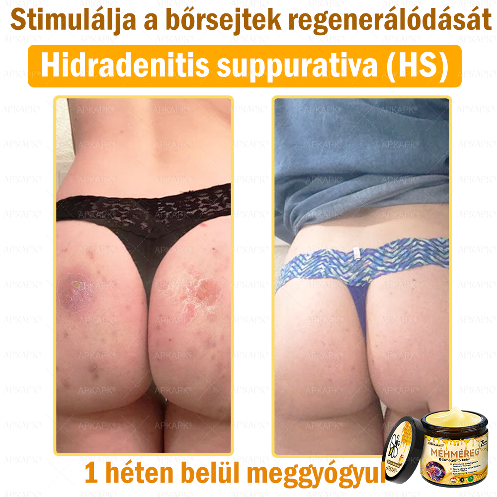 ✨💜💜APKAPK® 𝐌É𝐇𝐌É𝐑𝐄𝐆 Á𝐓𝐅𝐎𝐆Ó 𝐊𝐑É𝐌🥇𝐀 bőrnövedékek 𝐤𝐞𝐳𝐞𝐥é𝐬𝐞 𝐦𝐚𝐠á𝐛𝐚𝐧 𝐟𝐨𝐠𝐥𝐚𝐥𝐣𝐚: é𝐥𝐞𝐭𝐤𝐨𝐫𝐢 𝐟𝐨𝐥𝐭𝐨𝐤, 𝐡𝐞𝐠𝐞𝐤, 𝐬𝐳𝐞𝐦ö𝐥𝐜𝐬ö𝐤, 𝐛ö𝐫𝐧ö𝐯𝐞𝐝é𝐤𝐞𝐤, 𝐭á𝐥𝐲𝐨𝐠𝐨𝐤, 𝐩𝐚𝐭𝐭𝐚𝐧á𝐬𝐨𝐤, 𝐞𝐤𝐜é𝐦𝐚, 𝐩𝐬𝐨𝐫𝐢𝐚𝐬𝐢𝐬, 𝐚𝐜𝐧𝐞 𝐢𝐧𝐯𝐞𝐫𝐬𝐚, 𝐫á𝐧𝐜𝐨𝐤, 𝐛ö𝐫ö𝐫𝐞𝐠𝐞𝐝é𝐬 é𝐬 𝐞𝐠𝐲é𝐛 𝐩𝐫𝐨𝐛𝐥é𝐦á𝐤🔥