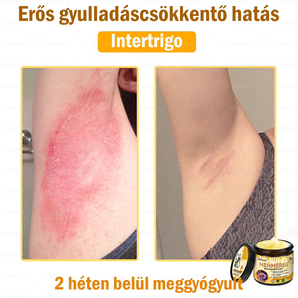 ✨💜💜APKAPK® 𝐌É𝐇𝐌É𝐑𝐄𝐆 Á𝐓𝐅𝐎𝐆Ó 𝐊𝐑É𝐌🥇𝐀 bőrnövedékek 𝐤𝐞𝐳𝐞𝐥é𝐬𝐞 𝐦𝐚𝐠á𝐛𝐚𝐧 𝐟𝐨𝐠𝐥𝐚𝐥𝐣𝐚: é𝐥𝐞𝐭𝐤𝐨𝐫𝐢 𝐟𝐨𝐥𝐭𝐨𝐤, 𝐡𝐞𝐠𝐞𝐤, 𝐬𝐳𝐞𝐦ö𝐥𝐜𝐬ö𝐤, 𝐛ö𝐫𝐧ö𝐯𝐞𝐝é𝐤𝐞𝐤, 𝐭á𝐥𝐲𝐨𝐠𝐨𝐤, 𝐩𝐚𝐭𝐭𝐚𝐧á𝐬𝐨𝐤, 𝐞𝐤𝐜é𝐦𝐚, 𝐩𝐬𝐨𝐫𝐢𝐚𝐬𝐢𝐬, 𝐚𝐜𝐧𝐞 𝐢𝐧𝐯𝐞𝐫𝐬𝐚, 𝐫á𝐧𝐜𝐨𝐤, 𝐛ö𝐫ö𝐫𝐞𝐠𝐞𝐝é𝐬 é𝐬 𝐞𝐠𝐲é𝐛 𝐩𝐫𝐨𝐛𝐥é𝐦á𝐤🔥