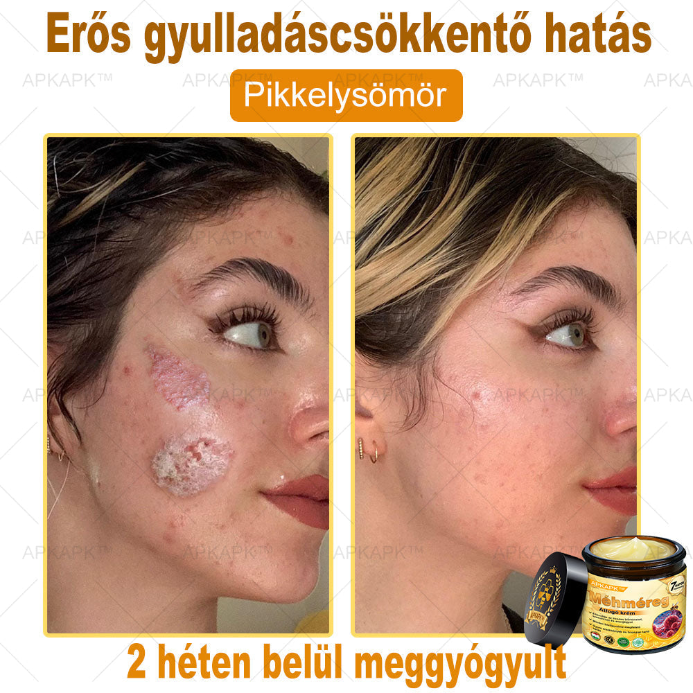 ✨🥇𝐀𝐏𝐊𝐀𝐏𝐊® 𝐌É𝐇𝐌É𝐑𝐄𝐆 Á𝐓𝐅𝐎𝐆Ó 𝐊𝐑É𝐌🥇𝐀 𝐛ö𝐫𝐩𝐫𝐨𝐛𝐥é𝐦á𝐤 𝐤𝐞𝐳𝐞𝐥é𝐬𝐞 𝐦𝐚𝐠á𝐛𝐚𝐧 𝐟𝐨𝐠𝐥𝐚𝐥𝐣𝐚: é𝐥𝐞𝐭𝐤𝐨𝐫𝐢 𝐟𝐨𝐥𝐭𝐨𝐤, 𝐡𝐞𝐠𝐞𝐤, 𝐬𝐳𝐞𝐦ö𝐥𝐜𝐬ö𝐤, 𝐛ö𝐫𝐧ö𝐯𝐞𝐝é𝐤𝐞𝐤, 𝐭á𝐥𝐲𝐨𝐠𝐨𝐤, 𝐩𝐚𝐭𝐭𝐚𝐧á𝐬𝐨𝐤, 𝐞𝐤𝐜é𝐦𝐚, 𝐩𝐬𝐨𝐫𝐢𝐚𝐬𝐢𝐬, 𝐚𝐜𝐧𝐞 𝐢𝐧𝐯𝐞𝐫𝐬𝐚, 𝐫á𝐧𝐜𝐨𝐤, 𝐛ö𝐫ö𝐫𝐞𝐠𝐞𝐝é𝐬 é𝐬 𝐞𝐠𝐲é𝐛 𝐩𝐫𝐨𝐛𝐥é𝐦á𝐤🔥