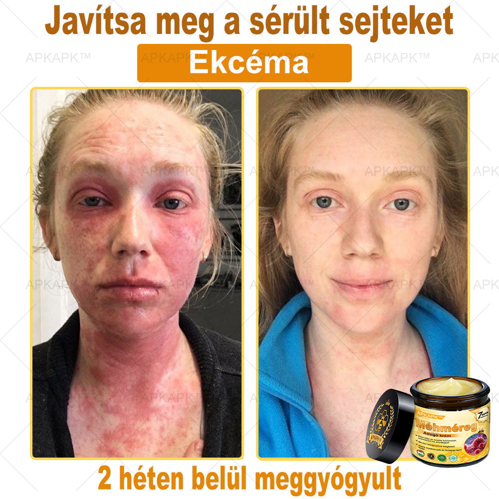 ✨🥇𝐀𝐏𝐊𝐀𝐏𝐊® 𝐌É𝐇𝐌É𝐑𝐄𝐆 Á𝐓𝐅𝐎𝐆Ó 𝐊𝐑É𝐌🥇𝐀 𝐛ö𝐫𝐩𝐫𝐨𝐛𝐥é𝐦á𝐤 𝐤𝐞𝐳𝐞𝐥é𝐬𝐞 𝐦𝐚𝐠á𝐛𝐚𝐧 𝐟𝐨𝐠𝐥𝐚𝐥𝐣𝐚: é𝐥𝐞𝐭𝐤𝐨𝐫𝐢 𝐟𝐨𝐥𝐭𝐨𝐤, 𝐡𝐞𝐠𝐞𝐤, 𝐬𝐳𝐞𝐦ö𝐥𝐜𝐬ö𝐤, 𝐛ö𝐫𝐧ö𝐯𝐞𝐝é𝐤𝐞𝐤, 𝐭á𝐥𝐲𝐨𝐠𝐨𝐤, 𝐩𝐚𝐭𝐭𝐚𝐧á𝐬𝐨𝐤, 𝐞𝐤𝐜é𝐦𝐚, 𝐩𝐬𝐨𝐫𝐢𝐚𝐬𝐢𝐬, 𝐚𝐜𝐧𝐞 𝐢𝐧𝐯𝐞𝐫𝐬𝐚, 𝐫á𝐧𝐜𝐨𝐤, 𝐛ö𝐫ö𝐫𝐞𝐠𝐞𝐝é𝐬 é𝐬 𝐞𝐠𝐲é𝐛 𝐩𝐫𝐨𝐛𝐥é𝐦á𝐤🔥