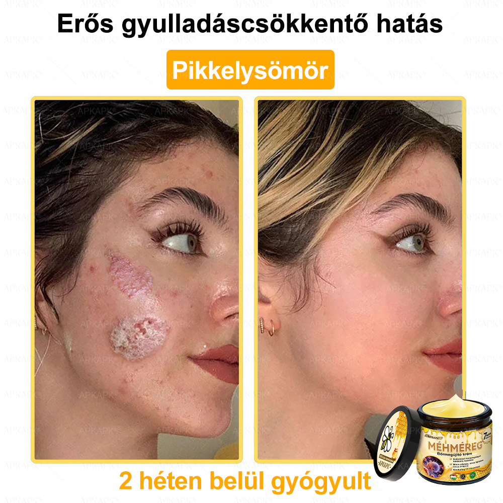 ✨💜💜APKAPK® 𝐌É𝐇𝐌É𝐑𝐄𝐆 Á𝐓𝐅𝐎𝐆Ó 𝐊𝐑É𝐌🥇𝐀 bőrnövedékek 𝐤𝐞𝐳𝐞𝐥é𝐬𝐞 𝐦𝐚𝐠á𝐛𝐚𝐧 𝐟𝐨𝐠𝐥𝐚𝐥𝐣𝐚: é𝐥𝐞𝐭𝐤𝐨𝐫𝐢 𝐟𝐨𝐥𝐭𝐨𝐤, 𝐡𝐞𝐠𝐞𝐤, 𝐬𝐳𝐞𝐦ö𝐥𝐜𝐬ö𝐤, 𝐛ö𝐫𝐧ö𝐯𝐞𝐝é𝐤𝐞𝐤, 𝐭á𝐥𝐲𝐨𝐠𝐨𝐤, 𝐩𝐚𝐭𝐭𝐚𝐧á𝐬𝐨𝐤, 𝐞𝐤𝐜é𝐦𝐚, 𝐩𝐬𝐨𝐫𝐢𝐚𝐬𝐢𝐬, 𝐚𝐜𝐧𝐞 𝐢𝐧𝐯𝐞𝐫𝐬𝐚, 𝐫á𝐧𝐜𝐨𝐤, 𝐛ö𝐫ö𝐫𝐞𝐠𝐞𝐝é𝐬 é𝐬 𝐞𝐠𝐲é𝐛 𝐩𝐫𝐨𝐛𝐥é𝐦á𝐤🔥