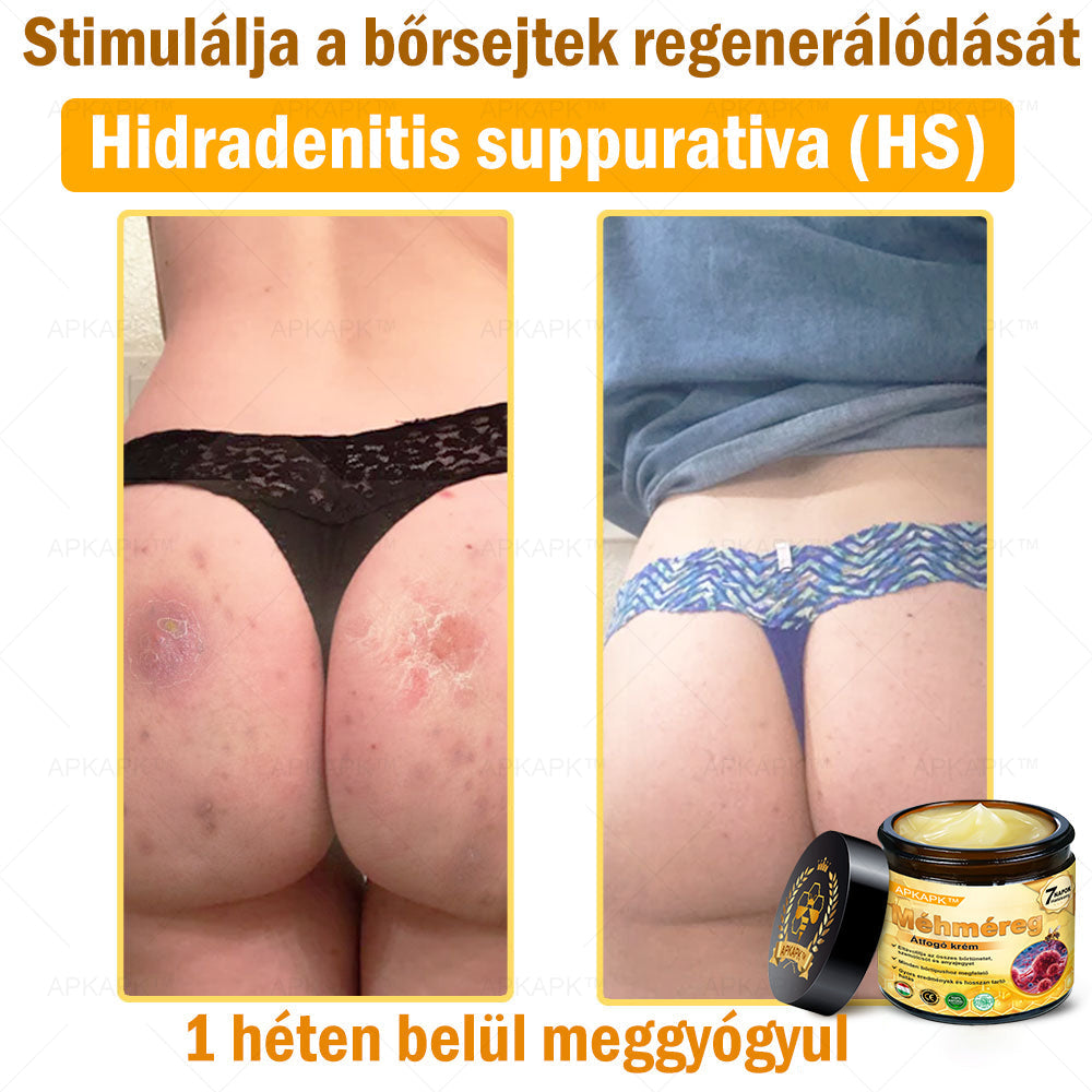 ✨🥇𝐀𝐏𝐊𝐀𝐏𝐊® 𝐌É𝐇𝐌É𝐑𝐄𝐆 Á𝐓𝐅𝐎𝐆Ó 𝐊𝐑É𝐌🥇𝐀 𝐛ö𝐫𝐩𝐫𝐨𝐛𝐥é𝐦á𝐤 𝐤𝐞𝐳𝐞𝐥é𝐬𝐞 𝐦𝐚𝐠á𝐛𝐚𝐧 𝐟𝐨𝐠𝐥𝐚𝐥𝐣𝐚: é𝐥𝐞𝐭𝐤𝐨𝐫𝐢 𝐟𝐨𝐥𝐭𝐨𝐤, 𝐡𝐞𝐠𝐞𝐤, 𝐬𝐳𝐞𝐦ö𝐥𝐜𝐬ö𝐤, 𝐛ö𝐫𝐧ö𝐯𝐞𝐝é𝐤𝐞𝐤, 𝐭á𝐥𝐲𝐨𝐠𝐨𝐤, 𝐩𝐚𝐭𝐭𝐚𝐧á𝐬𝐨𝐤, 𝐞𝐤𝐜é𝐦𝐚, 𝐩𝐬𝐨𝐫𝐢𝐚𝐬𝐢𝐬, 𝐚𝐜𝐧𝐞 𝐢𝐧𝐯𝐞𝐫𝐬𝐚, 𝐫á𝐧𝐜𝐨𝐤, 𝐛ö𝐫ö𝐫𝐞𝐠𝐞𝐝é𝐬 é𝐬 𝐞𝐠𝐲é𝐛 𝐩𝐫𝐨𝐛𝐥é𝐦á𝐤🔥