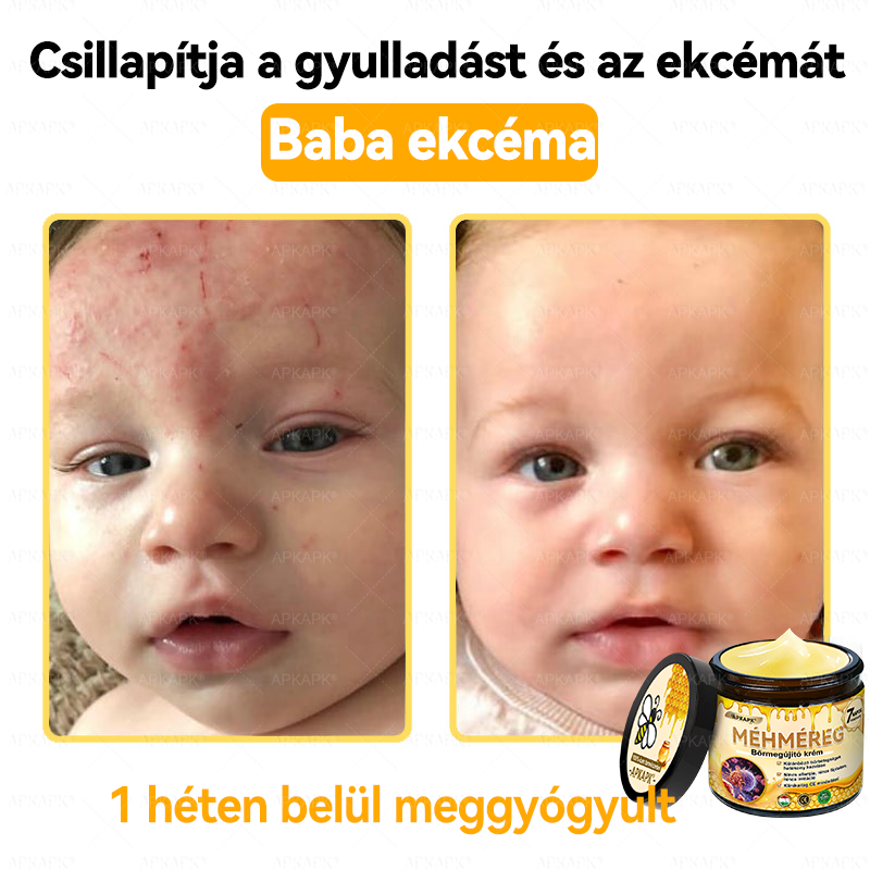 ✨💜💜APKAPK® 𝐌É𝐇𝐌É𝐑𝐄𝐆 Á𝐓𝐅𝐎𝐆Ó 𝐊𝐑É𝐌🥇𝐀 bőrnövedékek 𝐤𝐞𝐳𝐞𝐥é𝐬𝐞 𝐦𝐚𝐠á𝐛𝐚𝐧 𝐟𝐨𝐠𝐥𝐚𝐥𝐣𝐚: é𝐥𝐞𝐭𝐤𝐨𝐫𝐢 𝐟𝐨𝐥𝐭𝐨𝐤, 𝐡𝐞𝐠𝐞𝐤, 𝐬𝐳𝐞𝐦ö𝐥𝐜𝐬ö𝐤, 𝐛ö𝐫𝐧ö𝐯𝐞𝐝é𝐤𝐞𝐤, 𝐭á𝐥𝐲𝐨𝐠𝐨𝐤, 𝐩𝐚𝐭𝐭𝐚𝐧á𝐬𝐨𝐤, 𝐞𝐤𝐜é𝐦𝐚, 𝐩𝐬𝐨𝐫𝐢𝐚𝐬𝐢𝐬, 𝐚𝐜𝐧𝐞 𝐢𝐧𝐯𝐞𝐫𝐬𝐚, 𝐫á𝐧𝐜𝐨𝐤, 𝐛ö𝐫ö𝐫𝐞𝐠𝐞𝐝é𝐬 é𝐬 𝐞𝐠𝐲é𝐛 𝐩𝐫𝐨𝐛𝐥é𝐦á𝐤🔥