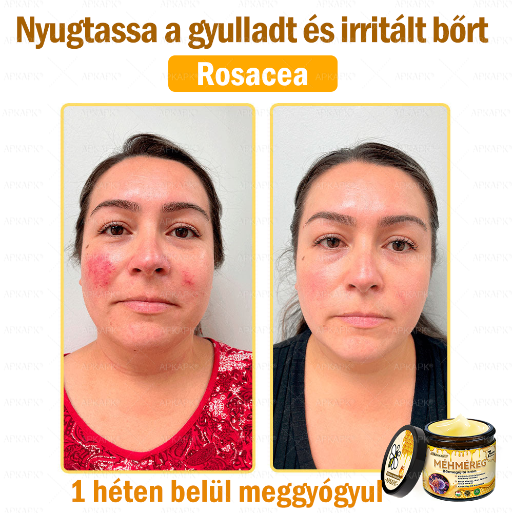 ✨💜💜APKAPK® 𝐌É𝐇𝐌É𝐑𝐄𝐆 Á𝐓𝐅𝐎𝐆Ó 𝐊𝐑É𝐌🥇𝐀 bőrnövedékek 𝐤𝐞𝐳𝐞𝐥é𝐬𝐞 𝐦𝐚𝐠á𝐛𝐚𝐧 𝐟𝐨𝐠𝐥𝐚𝐥𝐣𝐚: é𝐥𝐞𝐭𝐤𝐨𝐫𝐢 𝐟𝐨𝐥𝐭𝐨𝐤, 𝐡𝐞𝐠𝐞𝐤, 𝐬𝐳𝐞𝐦ö𝐥𝐜𝐬ö𝐤, 𝐛ö𝐫𝐧ö𝐯𝐞𝐝é𝐤𝐞𝐤, 𝐭á𝐥𝐲𝐨𝐠𝐨𝐤, 𝐩𝐚𝐭𝐭𝐚𝐧á𝐬𝐨𝐤, 𝐞𝐤𝐜é𝐦𝐚, 𝐩𝐬𝐨𝐫𝐢𝐚𝐬𝐢𝐬, 𝐚𝐜𝐧𝐞 𝐢𝐧𝐯𝐞𝐫𝐬𝐚, 𝐫á𝐧𝐜𝐨𝐤, 𝐛ö𝐫ö𝐫𝐞𝐠𝐞𝐝é𝐬 é𝐬 𝐞𝐠𝐲é𝐛 𝐩𝐫𝐨𝐛𝐥é𝐦á𝐤🔥