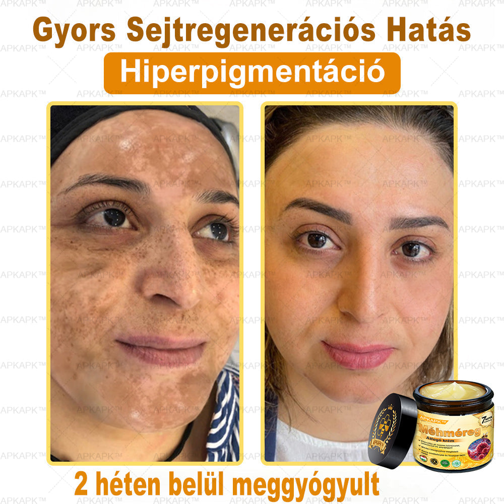 ✨🥇𝐀𝐏𝐊𝐀𝐏𝐊® 𝐌É𝐇𝐌É𝐑𝐄𝐆 Á𝐓𝐅𝐎𝐆Ó 𝐊𝐑É𝐌🥇𝐀 𝐛ö𝐫𝐩𝐫𝐨𝐛𝐥é𝐦á𝐤 𝐤𝐞𝐳𝐞𝐥é𝐬𝐞 𝐦𝐚𝐠á𝐛𝐚𝐧 𝐟𝐨𝐠𝐥𝐚𝐥𝐣𝐚: é𝐥𝐞𝐭𝐤𝐨𝐫𝐢 𝐟𝐨𝐥𝐭𝐨𝐤, 𝐡𝐞𝐠𝐞𝐤, 𝐬𝐳𝐞𝐦ö𝐥𝐜𝐬ö𝐤, 𝐛ö𝐫𝐧ö𝐯𝐞𝐝é𝐤𝐞𝐤, 𝐭á𝐥𝐲𝐨𝐠𝐨𝐤, 𝐩𝐚𝐭𝐭𝐚𝐧á𝐬𝐨𝐤, 𝐞𝐤𝐜é𝐦𝐚, 𝐩𝐬𝐨𝐫𝐢𝐚𝐬𝐢𝐬, 𝐚𝐜𝐧𝐞 𝐢𝐧𝐯𝐞𝐫𝐬𝐚, 𝐫á𝐧𝐜𝐨𝐤, 𝐛ö𝐫ö𝐫𝐞𝐠𝐞𝐝é𝐬 é𝐬 𝐞𝐠𝐲é𝐛 𝐩𝐫𝐨𝐛𝐥é𝐦á𝐤🔥