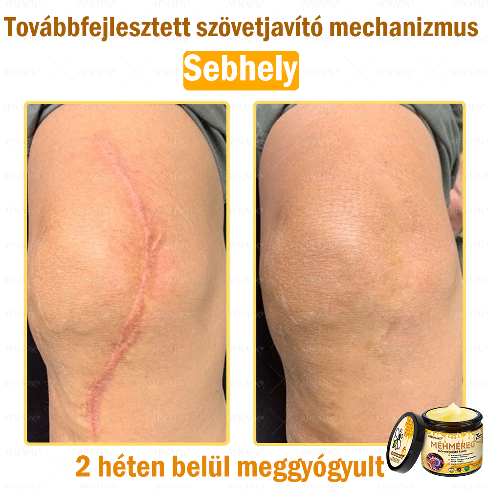 ✨💜💜APKAPK® 𝐌É𝐇𝐌É𝐑𝐄𝐆 Á𝐓𝐅𝐎𝐆Ó 𝐊𝐑É𝐌🥇𝐀 bőrnövedékek 𝐤𝐞𝐳𝐞𝐥é𝐬𝐞 𝐦𝐚𝐠á𝐛𝐚𝐧 𝐟𝐨𝐠𝐥𝐚𝐥𝐣𝐚: é𝐥𝐞𝐭𝐤𝐨𝐫𝐢 𝐟𝐨𝐥𝐭𝐨𝐤, 𝐡𝐞𝐠𝐞𝐤, 𝐬𝐳𝐞𝐦ö𝐥𝐜𝐬ö𝐤, 𝐛ö𝐫𝐧ö𝐯𝐞𝐝é𝐤𝐞𝐤, 𝐭á𝐥𝐲𝐨𝐠𝐨𝐤, 𝐩𝐚𝐭𝐭𝐚𝐧á𝐬𝐨𝐤, 𝐞𝐤𝐜é𝐦𝐚, 𝐩𝐬𝐨𝐫𝐢𝐚𝐬𝐢𝐬, 𝐚𝐜𝐧𝐞 𝐢𝐧𝐯𝐞𝐫𝐬𝐚, 𝐫á𝐧𝐜𝐨𝐤, 𝐛ö𝐫ö𝐫𝐞𝐠𝐞𝐝é𝐬 é𝐬 𝐞𝐠𝐲é𝐛 𝐩𝐫𝐨𝐛𝐥é𝐦á𝐤🔥