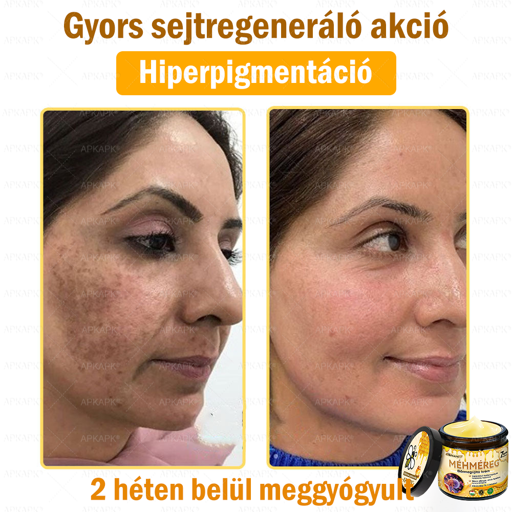 ✨💜💜APKAPK® 𝐌É𝐇𝐌É𝐑𝐄𝐆 Á𝐓𝐅𝐎𝐆Ó 𝐊𝐑É𝐌🥇𝐀 bőrnövedékek 𝐤𝐞𝐳𝐞𝐥é𝐬𝐞 𝐦𝐚𝐠á𝐛𝐚𝐧 𝐟𝐨𝐠𝐥𝐚𝐥𝐣𝐚: é𝐥𝐞𝐭𝐤𝐨𝐫𝐢 𝐟𝐨𝐥𝐭𝐨𝐤, 𝐡𝐞𝐠𝐞𝐤, 𝐬𝐳𝐞𝐦ö𝐥𝐜𝐬ö𝐤, 𝐛ö𝐫𝐧ö𝐯𝐞𝐝é𝐤𝐞𝐤, 𝐭á𝐥𝐲𝐨𝐠𝐨𝐤, 𝐩𝐚𝐭𝐭𝐚𝐧á𝐬𝐨𝐤, 𝐞𝐤𝐜é𝐦𝐚, 𝐩𝐬𝐨𝐫𝐢𝐚𝐬𝐢𝐬, 𝐚𝐜𝐧𝐞 𝐢𝐧𝐯𝐞𝐫𝐬𝐚, 𝐫á𝐧𝐜𝐨𝐤, 𝐛ö𝐫ö𝐫𝐞𝐠𝐞𝐝é𝐬 é𝐬 𝐞𝐠𝐲é𝐛 𝐩𝐫𝐨𝐛𝐥é𝐦á𝐤🔥
